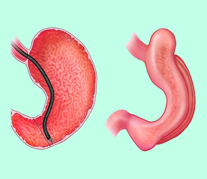 mucosectomia por endoscopia